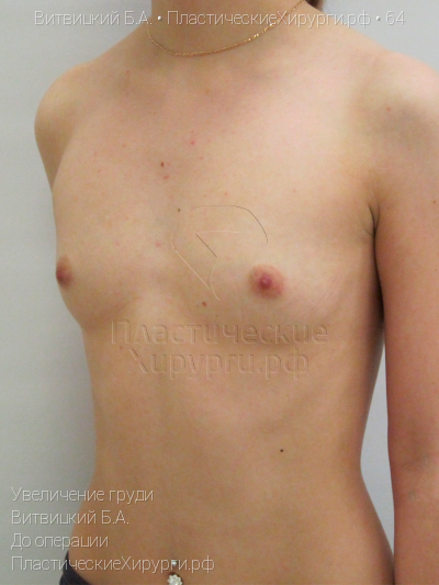 увеличение груди, пластический хирург Витвицкий Б. А., результат №64, ракурс 3, фото до операции