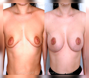 увеличение груди, результат №33, предварительное изображение до и после операции