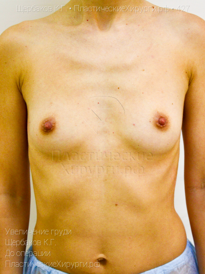 увеличение груди, пластический хирург Щербаков К. Г., результат №427, ракурс 1, фото до операции