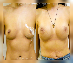увеличение груди, результат №431, предварительное изображение до и после операции