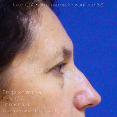 блефаропластика, пластический хирург Кузин Д. А., результат №329, ракурс 3, фото до операции