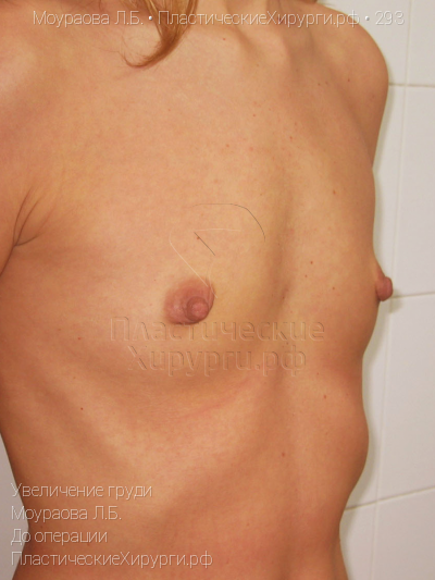 увеличение груди, пластический хирург Моураова Л. Б., результат №293, ракурс 2, фото до операции