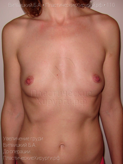 увеличение груди, пластический хирург Витвицкий Б. А., результат №110, ракурс 1, фото до операции