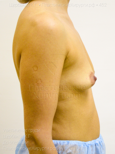 увеличение груди, пластический хирург Щербаков К. Г., результат №452, ракурс 3, фото до операции