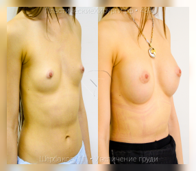 увеличение груди, результат №439, предварительное изображение до и после операции