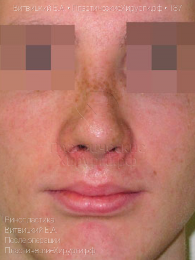 ринопластика, пластический хирург Витвицкий Б. А., результат №187, ракурс 1, фото после операции