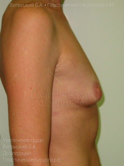 увеличение груди, пластический хирург Витвицкий Б. А., результат №95, ракурс 3, фото до операции