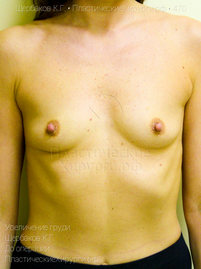 увеличение груди, пластический хирург Щербаков К. Г., результат №470, ракурс 1, фото до операции