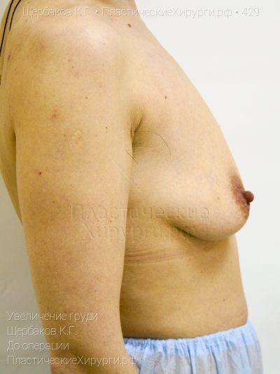 увеличение груди, пластический хирург Щербаков К. Г., результат №429, ракурс 3, фото до операции