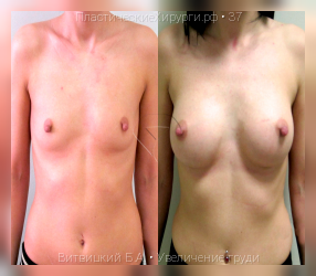 увеличение груди, результат №37, предварительное изображение до и после операции
