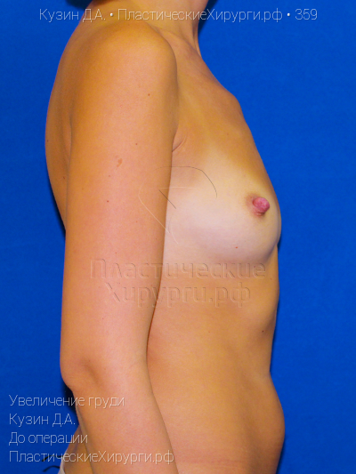 увеличение груди, пластический хирург Кузин Д. А., результат №359, ракурс 3, фото до операции