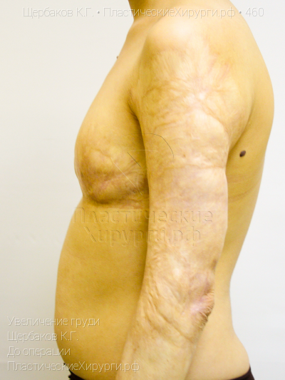 увеличение груди, пластический хирург Щербаков К. Г., результат №460, ракурс 5, фото до операции