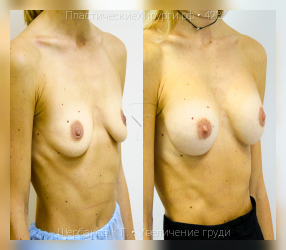 увеличение груди, результат №423, предварительное изображение до и после операции