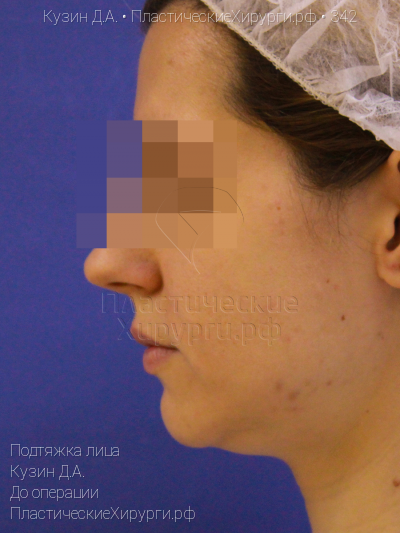 подтяжка лица, пластический хирург Кузин Д. А., результат №342, ракурс 3, фото до операции