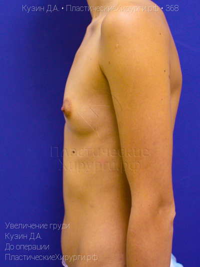 увеличение груди, пластический хирург Кузин Д. А., результат №368, ракурс 3, фото до операции
