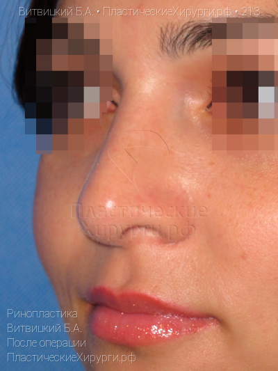 ринопластика, пластический хирург Витвицкий Б. А., результат №213, ракурс 3, фото после операции
