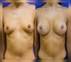увеличение груди, результат №358, предварительное изображение до и после операции