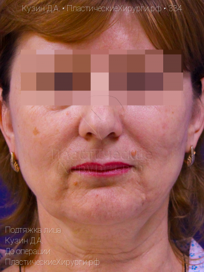 подтяжка лица, пластический хирург Кузин Д. А., результат №334, ракурс 1, фото до операции
