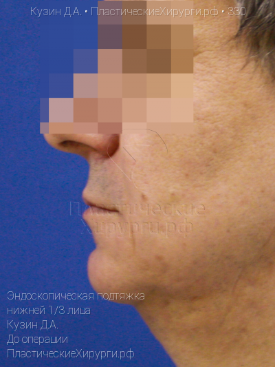 эндоскопическая подтяжка нижней трети лица, пластический хирург Кузин Д. А., результат №330, ракурс 3, фото до операции
