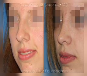 ринопластика, результат №306, предварительное изображение до и после операции
