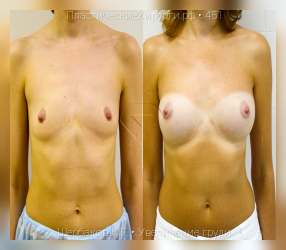 увеличение груди, результат №451, предварительное изображение до и после операции