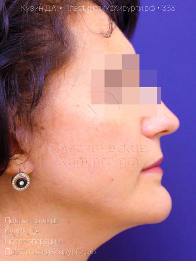 подтяжка лица, пластический хирург Кузин Д. А., результат №333, ракурс 3, фото после операции