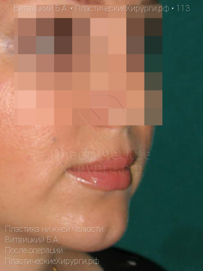 пластика нижней челюсти, пластический хирург Витвицкий Б. А., результат №113, ракурс 2, фото после операции