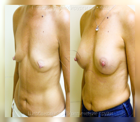 увеличение груди, результат №426, предварительное изображение до и после операции