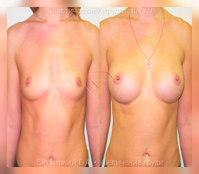 увеличение груди, результат №60, предварительное изображение до и после операции