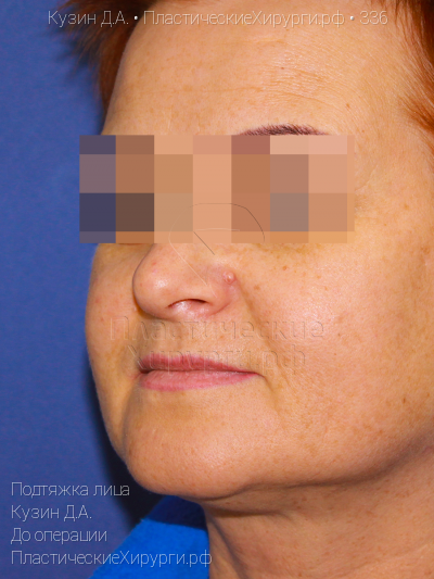 подтяжка лица, пластический хирург Кузин Д. А., результат №336, ракурс 2, фото до операции