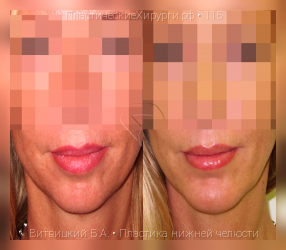 пластика нижней челюсти, результат №115, предварительное изображение до и после операции