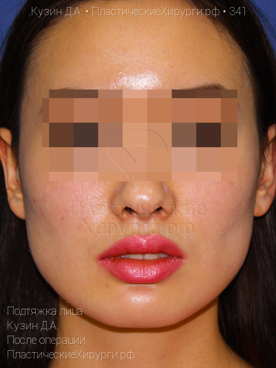 подтяжка лица, пластический хирург Кузин Д. А., результат №341, ракурс 1, фото после операции