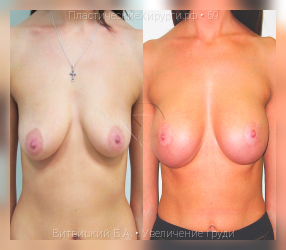 увеличение груди, результат №59, предварительное изображение до и после операции