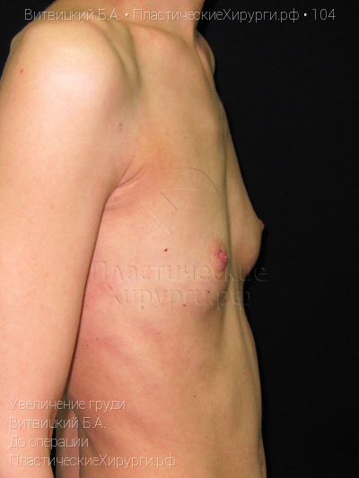 увеличение груди, пластический хирург Витвицкий Б. А., результат №104, ракурс 3, фото до операции