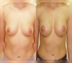 увеличение груди, результат №294, предварительное изображение до и после операции