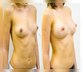 увеличение груди, результат №463, предварительное изображение до и после операции