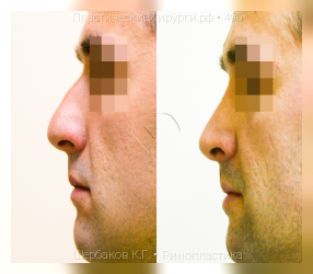 ринопластика, результат №490, предварительное изображение до и после операции