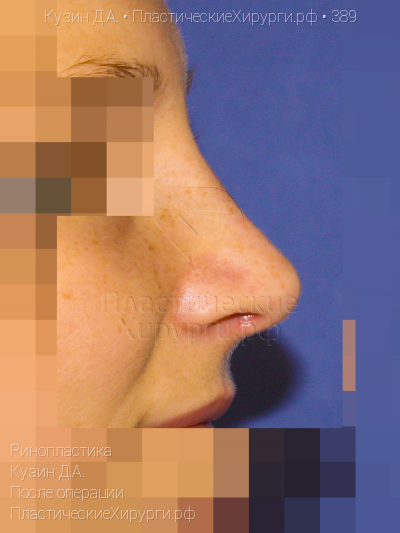 ринопластика, пластический хирург Кузин Д. А., результат №389, ракурс 3, фото после операции