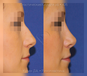 ринопластика, результат №408, предварительное изображение до и после операции