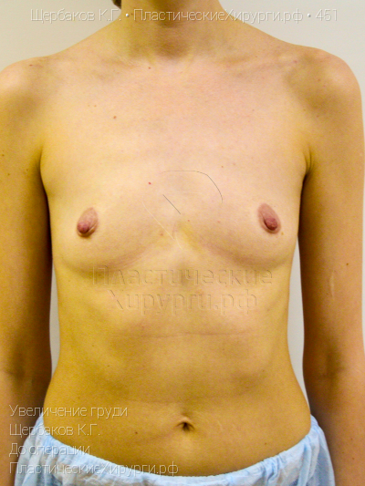 увеличение груди, пластический хирург Щербаков К. Г., результат №451, ракурс 1, фото до операции