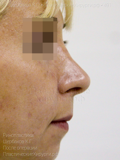 ринопластика, пластический хирург Щербаков К. Г., результат №491, ракурс 3, фото после операции