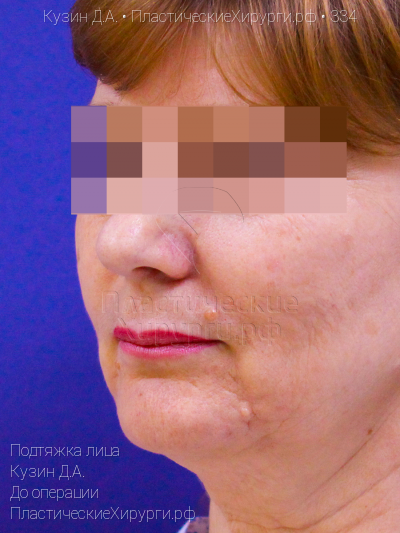 подтяжка лица, пластический хирург Кузин Д. А., результат №334, ракурс 4, фото до операции
