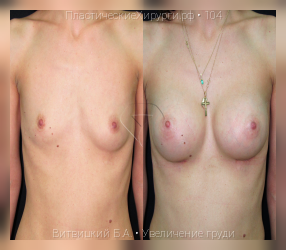увеличение груди, результат №104, предварительное изображение до и после операции