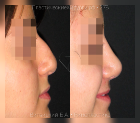 ринопластика, результат №278, предварительное изображение до и после операции