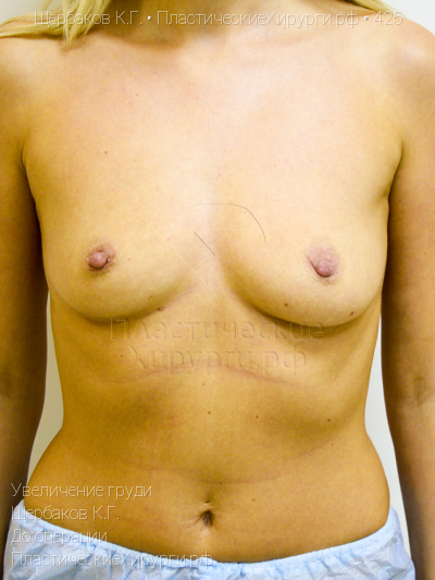 увеличение груди, пластический хирург Щербаков К. Г., результат №425, ракурс 1, фото до операции