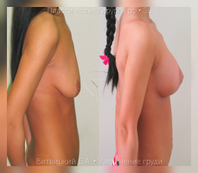 увеличение груди, результат №35, предварительное изображение до и после операции