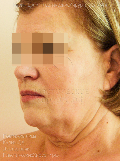 подтяжка лица, пластический хирург Кузин Д. А., результат №344, ракурс 2, фото до операции