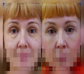 блефаропластика, результат №327, предварительное изображение до и после операции