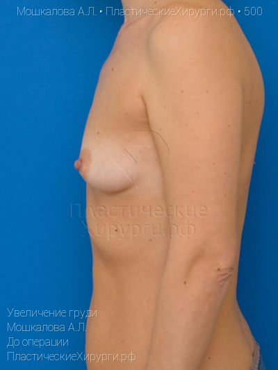 увеличение груди, пластический хирург Мошкалова А. Л., результат №500, ракурс 5, фото до операции