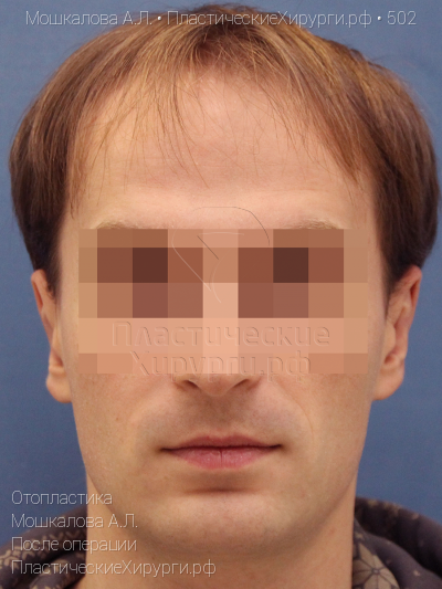 отопластика, пластический хирург Мошкалова А. Л., результат №502, ракурс 1, фото после операции